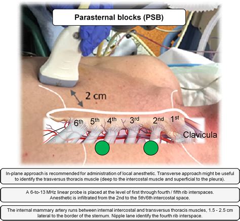 Intercostal nerve block cpt - Zheng Y, Wang H, Ma X, Cheng Z, Cao W, Shao D. Comparison of the effect of ultrasound-guided thoracic paravertebral nerve block and intercostal nerve block for video-assisted thoracic surgery under spontaneous-ventilating anesthesia. Rev Assoc Med Bras (1992). 2020;66(4):452-457. doi: 10.1590/1806-9282.66.4.452 [Google Scholar]